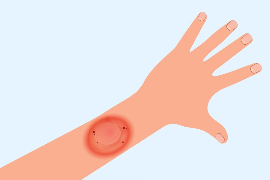 Kenali Jamur Ringworm yang Bisa Tertular Lewat Kucing Suryamedia.id